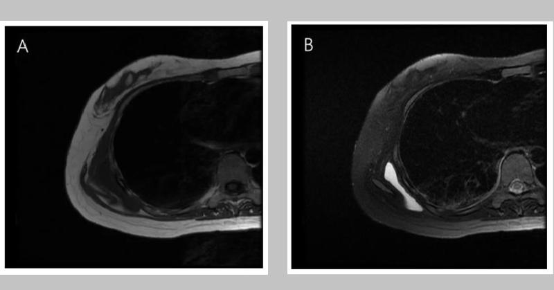 <p>Painful Shoulder Lump in Woman with SLE: What Could It Be?</p>