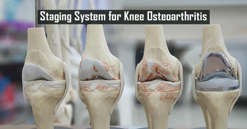Staging Systems for Knee Osteoarthritis