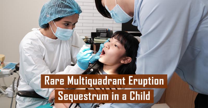 Multiquadrant Eruption Sequestrum in Pediatric First Permanent Molars