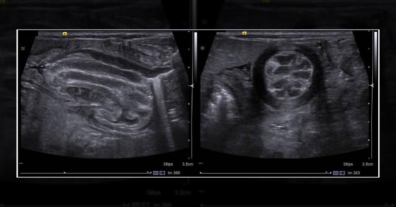 <p>Diagnosis of Severe Intrauterine Growth Retardation and Dysmorphic Features in a Newborn Male</p>
