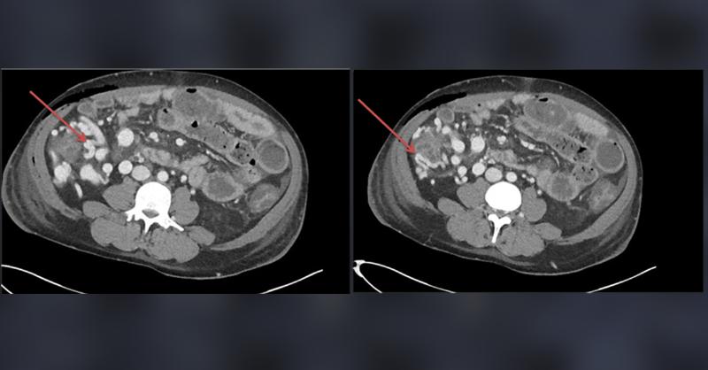 Cecal Varices in a 29-Year-Old Man with Alcoholic Liver Cirrhosis 