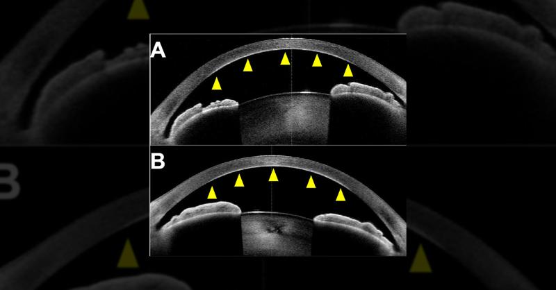 <p>Corneal Opacity in an Elderly Patient</p>