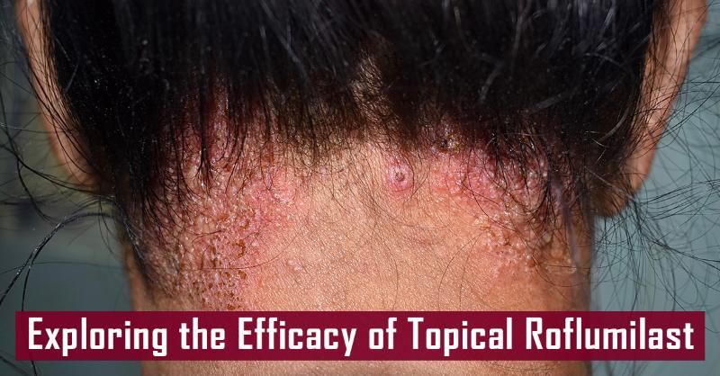 <p>Topical Roflumilast for Seborrheic Dermatitis</p>