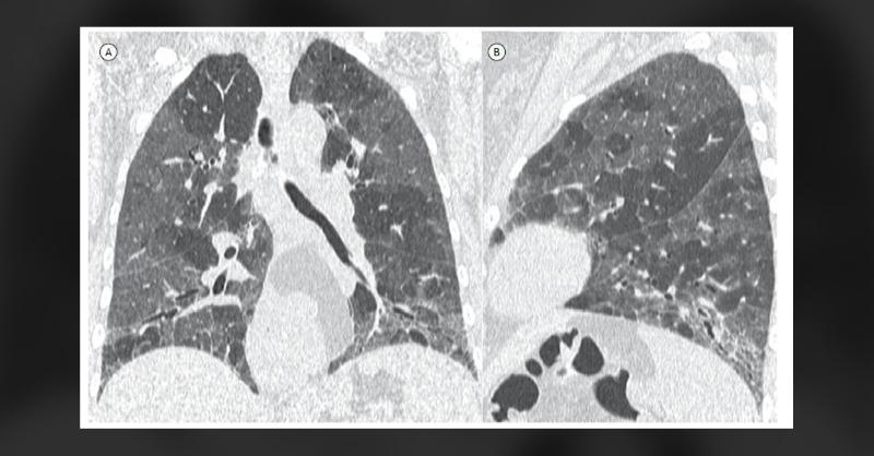 <p>Lung Pattern of Patient With Hypersensitivity Pneumonitis</p>