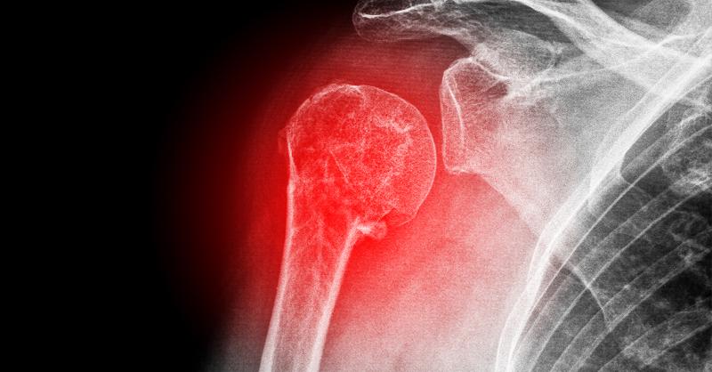 <p>ACJ fixation techniques versus coracoclavicular ligament fixation/reconstruction techniques for Acute Rockwood Grade III Acromioclavicular Joint Dislocations</p>