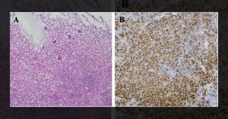 Diagnosis of a Patient Presenting with Progressive Wheeze, Cough, and Blood-Stained Sputum