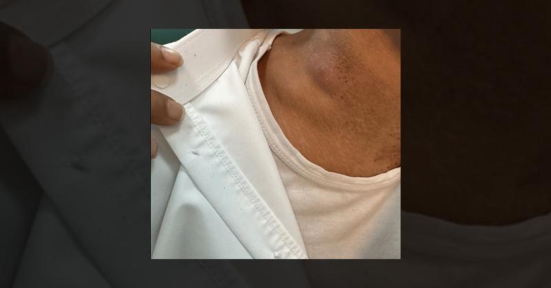 Management of Tuberculosis Lymphadenitis in a Young Adult