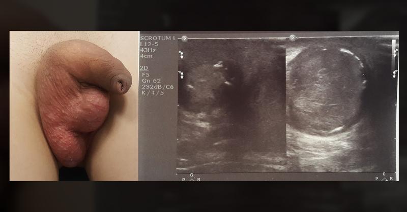 Management of Epididymitis Nodosa in a Child
