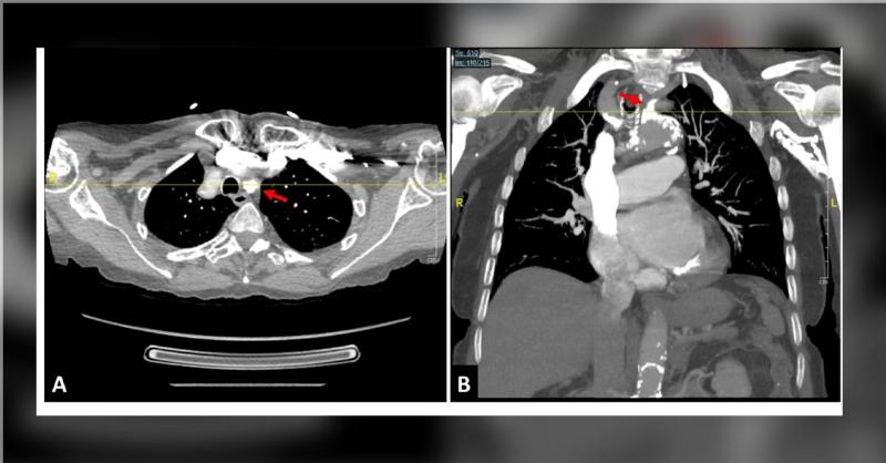 <p>Left Subclavian Artery Stenosis Identification in an Elderly Individual</p>