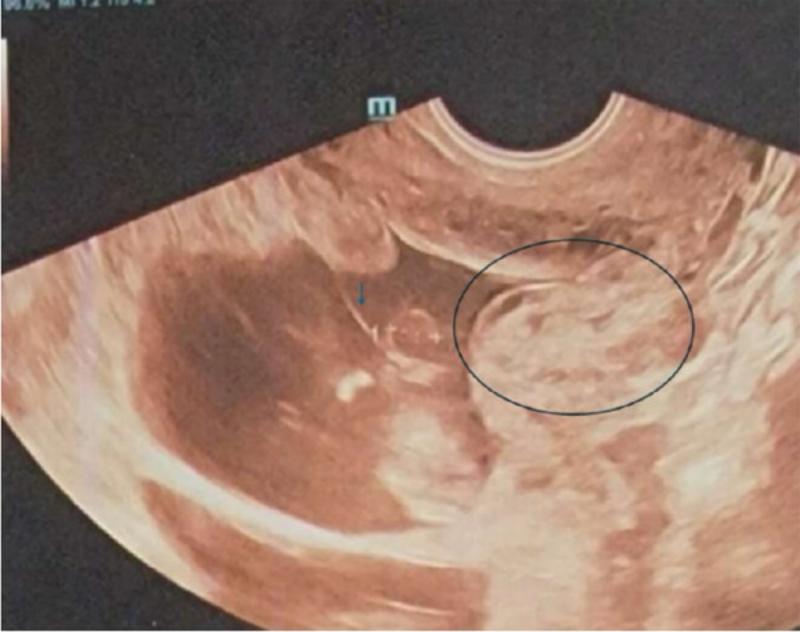Placenta Increta Due to a Demised Twin: A Rare Case in the Second Trimester