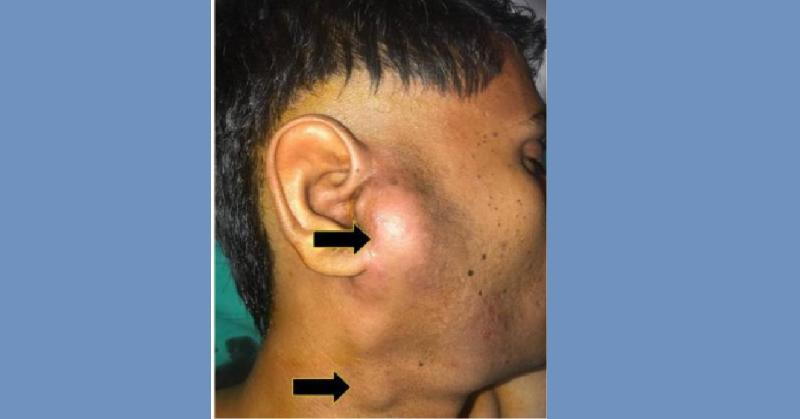 <p>Malignant Parotid Salivary Gland Tumur: Mucoepidermoid Carcinoma- Treated with Surgical Excision and Adjuvant Therapy</p>