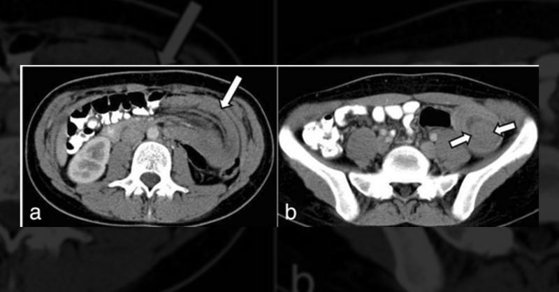 <p>Surgical Management of Intussusception in a Young Woman</p>