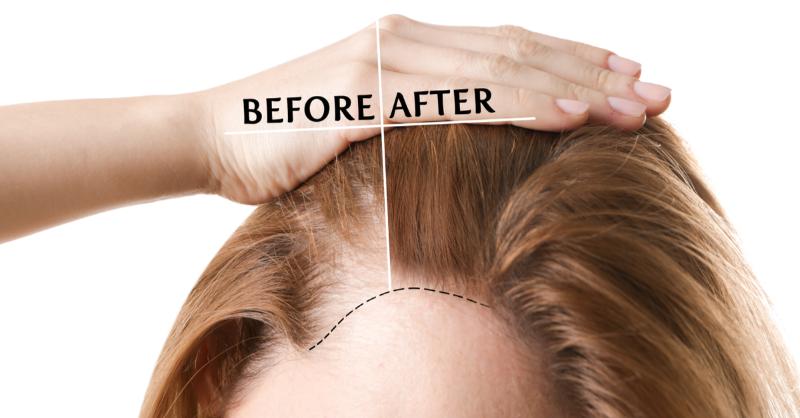 Effects of Hair Transplantation on the self image