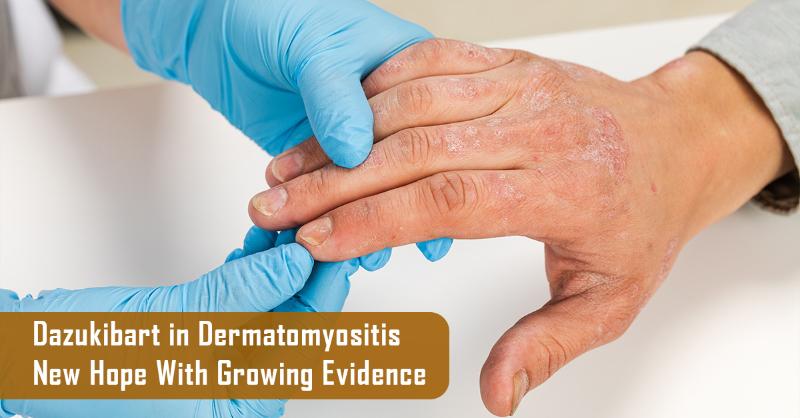 Dazukibart in Dermatomyositis as Emerging Evidence and Clinical Potential