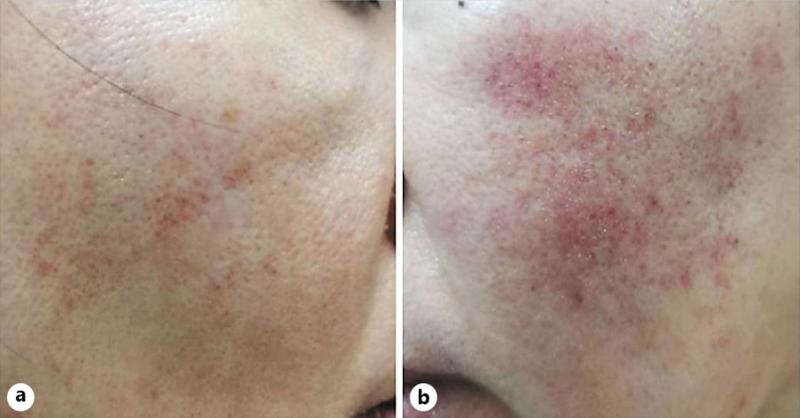 Demodicosis In an Adult Woman After Using the Mask