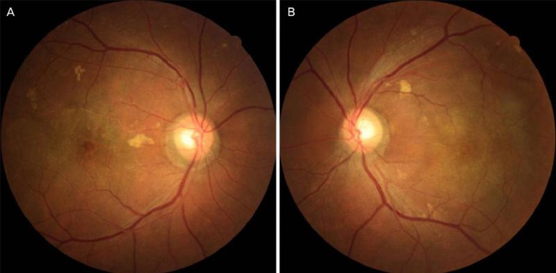 Overview of Central Serous Chorioretinopathy | MedSynapse