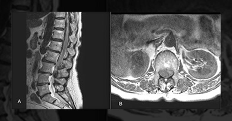 Spinal Hematoma as a Complication of Anaesthesia