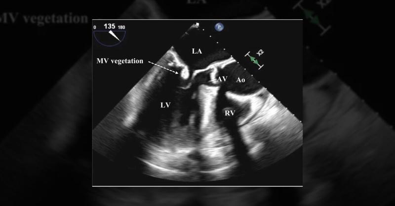 <p>Management of Mitral Valve Endocarditis by <em>T. pyogenes</em></p>