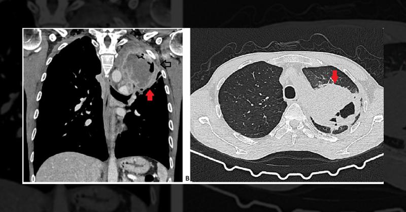 <p>Challenging Diagnosis of a Patient with Digital Clubbing and Arthralgia</p>