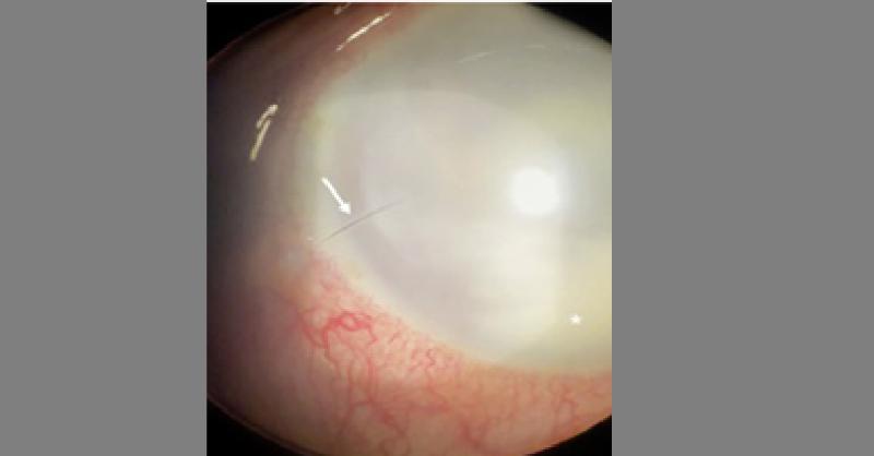 What Does This Post-Cataract Surgery Presentation of Eye Strain & Blurred Vision Indicate?
