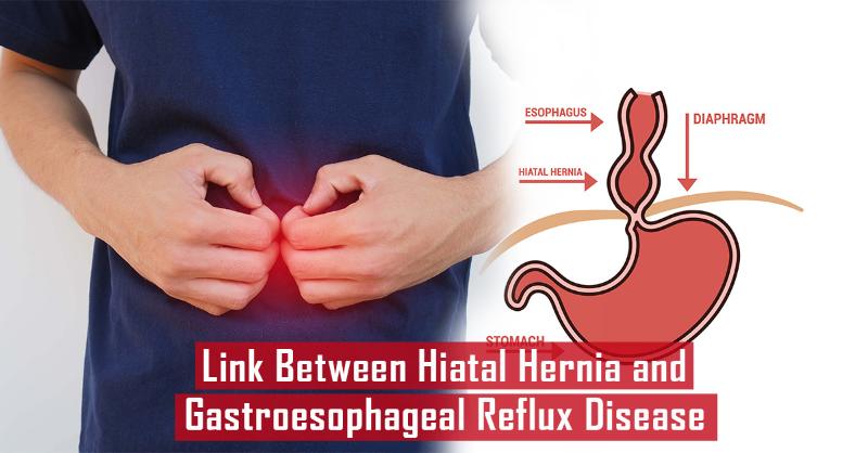 Comprehensive Overview of Hiatal Hernia and Management