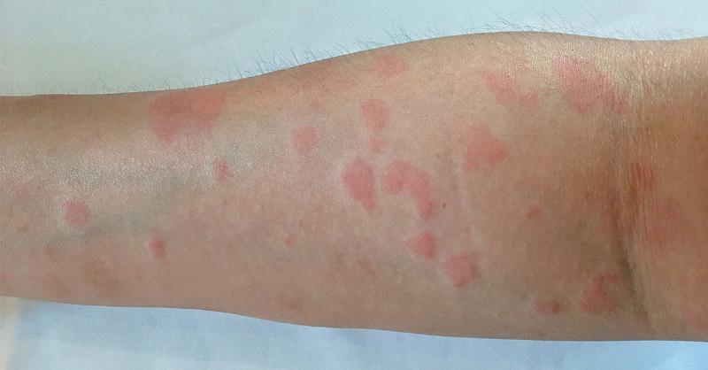 New-onset Systemic Lupus Erythematosus on Risankizumab for Psoriasis: A Case Report