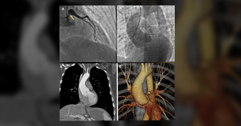 Challenging Case for Cardiologists...Diagnose this Woman when She Incidentally was Found to have Ectatic Aortic Root