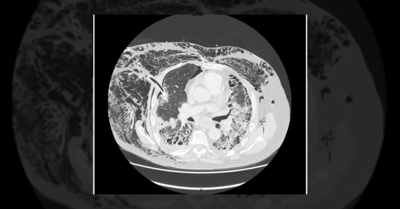 Management of an Elderly Patient with Chest Drain Malposition