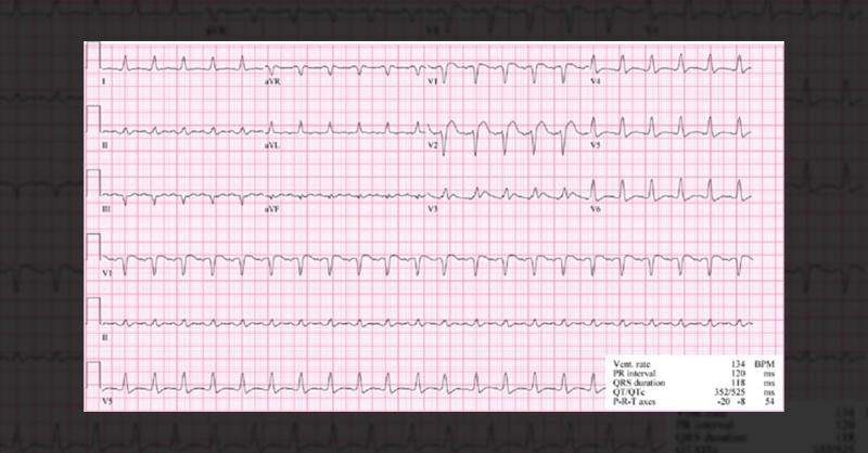 <p>Complex Cardiovascular Procedure for Aortic Valve and Aortic Repair: A Case Study</p>