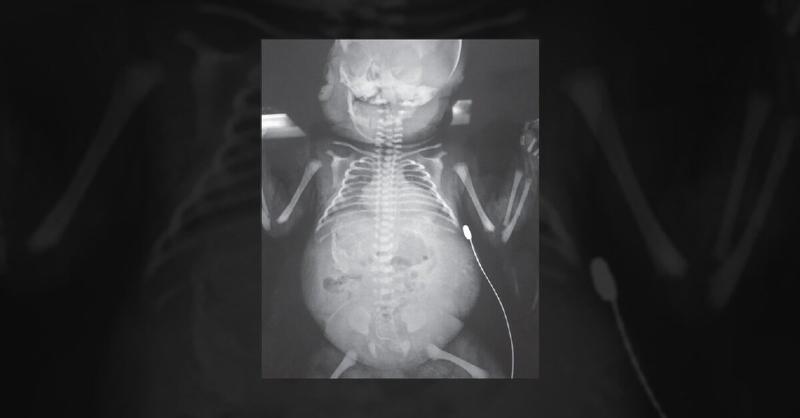 <p>Diagnosing a Case of Fetal Ascites and Edema After Birth</p>