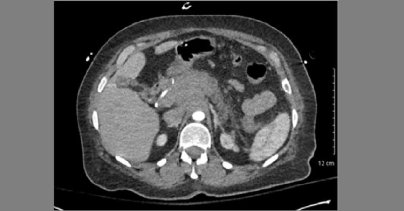 An Unusual Diagnosis of GI bleeding