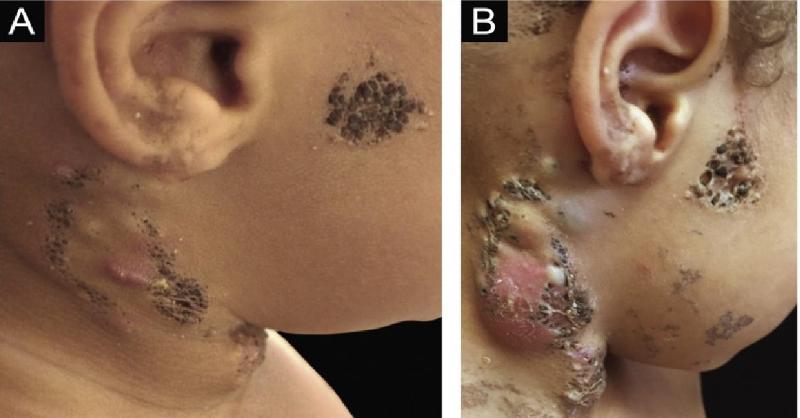 <p>Managing Nevus Comedonicus in a Four-Year-Old Child</p>