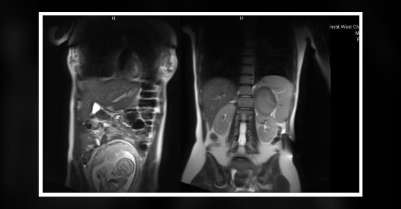 <p>How Will You Manage Cushing's Syndrome in Pregnancy?</p>