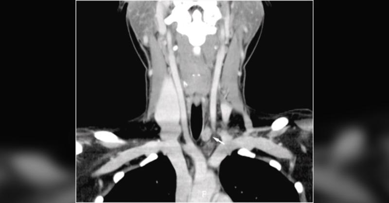 Coexistence of Left Recurrent and Non-recurrent Laryngeal Nerves in Thyroid Surgery: A Case Report