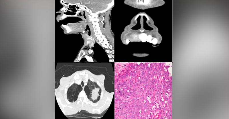 A Case of Untreated Dental Abscess Despite Tooth Extraction And Antibiotics