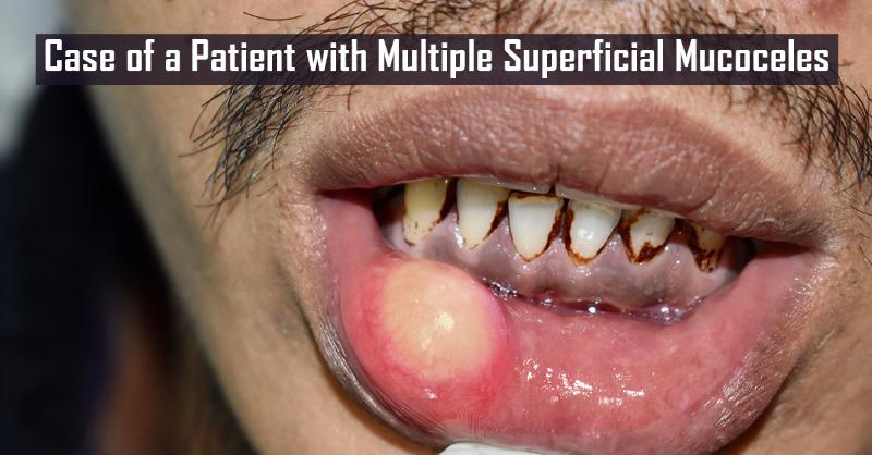 Multiple Superficial Mucoceles in a Patient suffering from Oral Lichen Planus