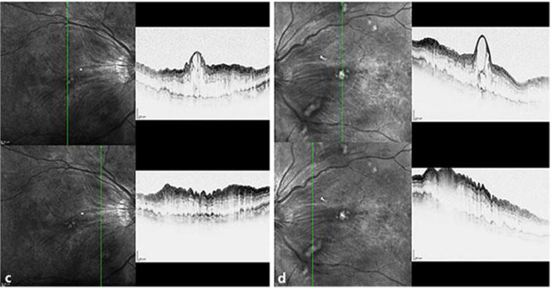 What is This Post-Cataract-Operative Macular Edema Indicating?