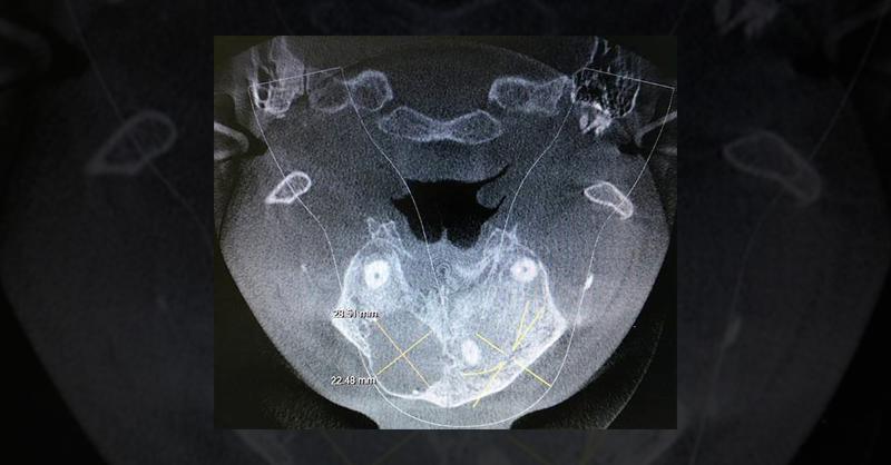 <p>Mandibular and Maxillary Challenges- CBCT Observations in a Young Man</p>