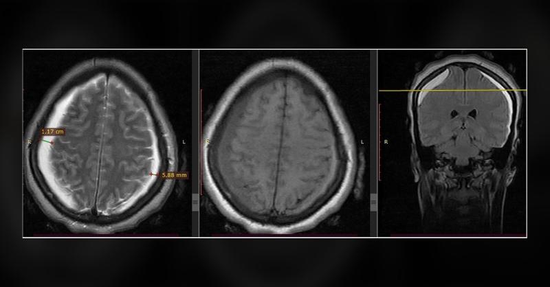 <p>Management of Chronic Bilateral Subdural Hematoma and Bilateral Abducens Nerve Palsy Post-Spinal Anesthesia</p>