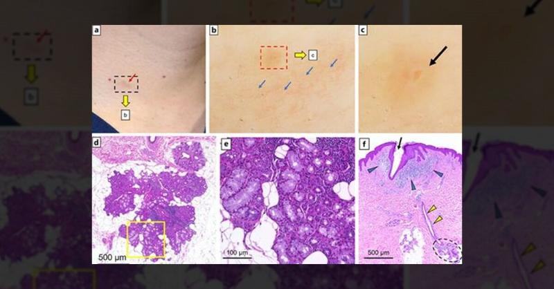 <p>A Case of Chronic Neck Lesion with Unique Histopathological Features</p>