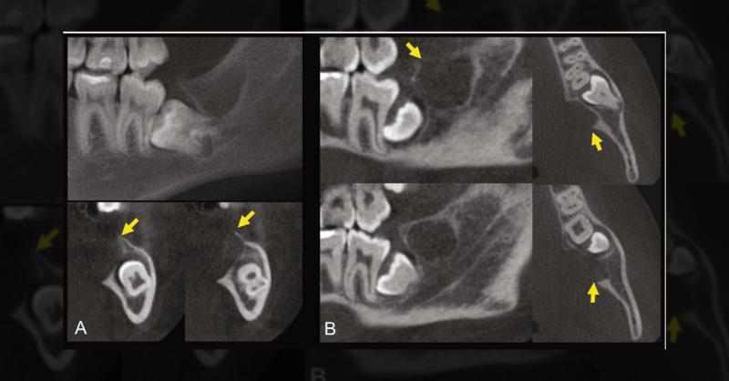 <p>Asymptomatic Osteolytic Lesion in the Mandible of a Teenage Patient</p>