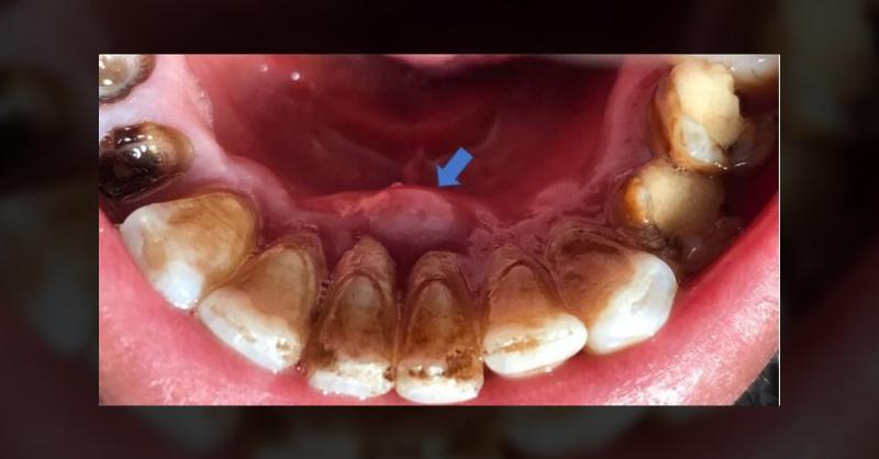 <p>Dx Please: A Case of Mandibular Anterior Pain and Gingival Swelling</p>