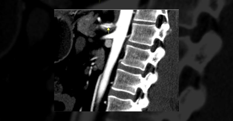 <p>Abdominal Pain Reveals Celiac Artery Dissection in a Middle-Aged Patient</p>