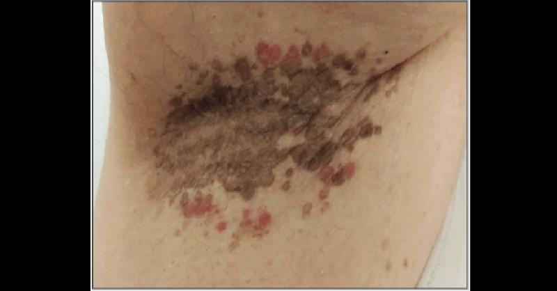 Identify the Disease of an Elderly Woman with Reddish-Brown Hyperkeratotic Papules
