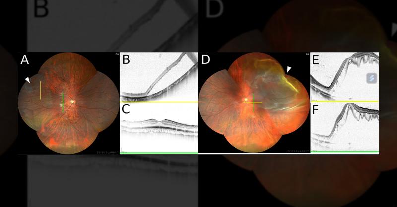 <p>Managing Bilateral Retinal Detachment in a Teenager</p>