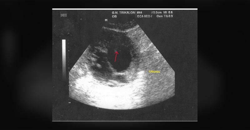 Unraveling the Cause of Severe Vaginal Bleeding in a Patient with a Positive Pregnancy Test