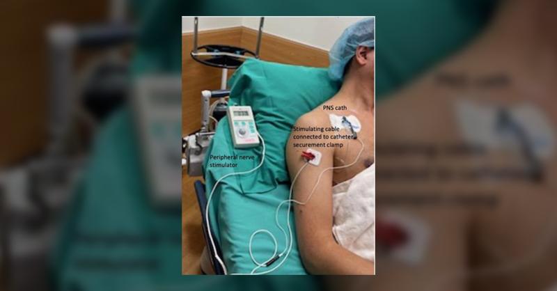 <p>The dry catheter regional anaesthesia technique in a 52 year female for shoulder athroplasty</p>