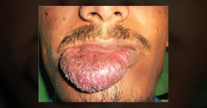 <p>A Giant Swelling of the Lower Lip</p>