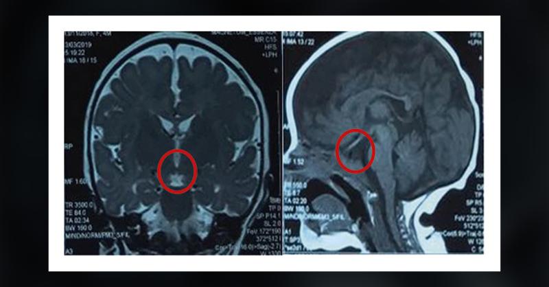 Endocrine Cause of Cholestatic Jaundice in a Neonate