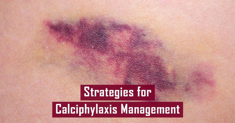 <p>Comprehensive Strategies for Treating and Preventing Calciphylaxis: A Multidisciplinary Approach</p>